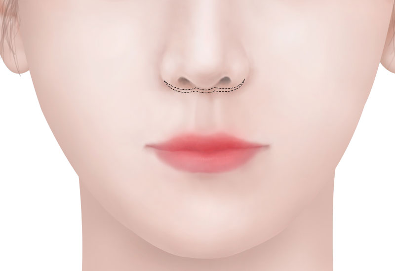 수술방법