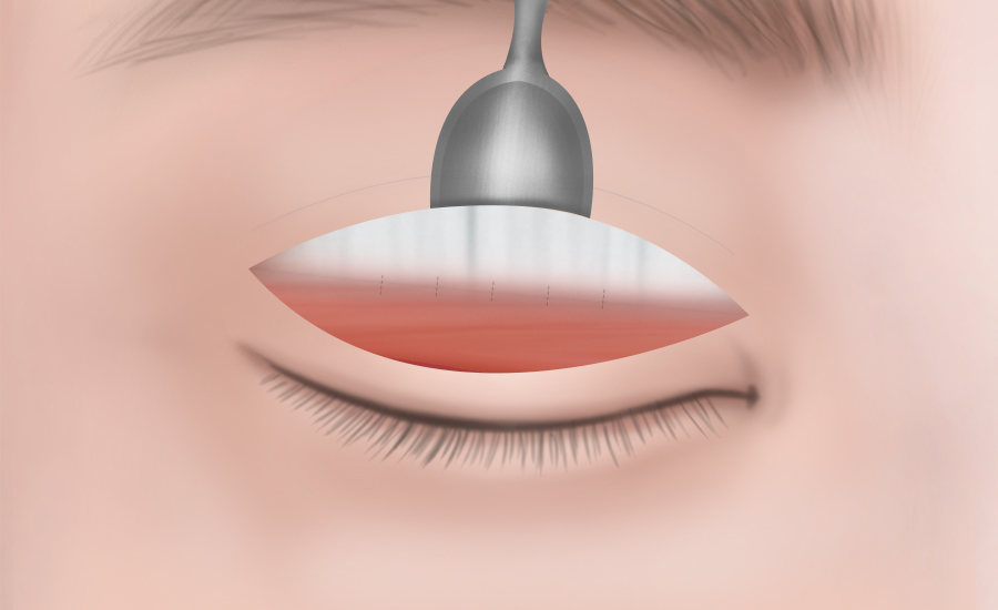 수술방법