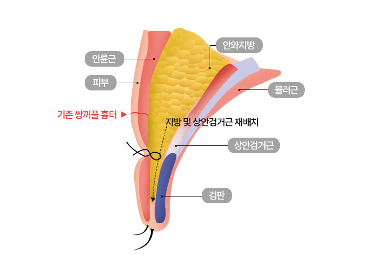 수술방법