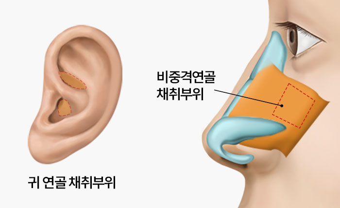수술방법