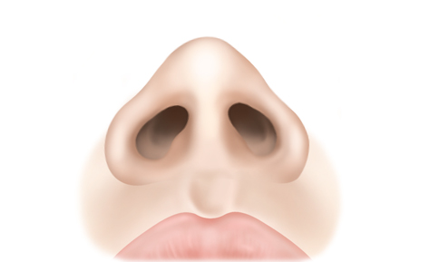 수술방법 